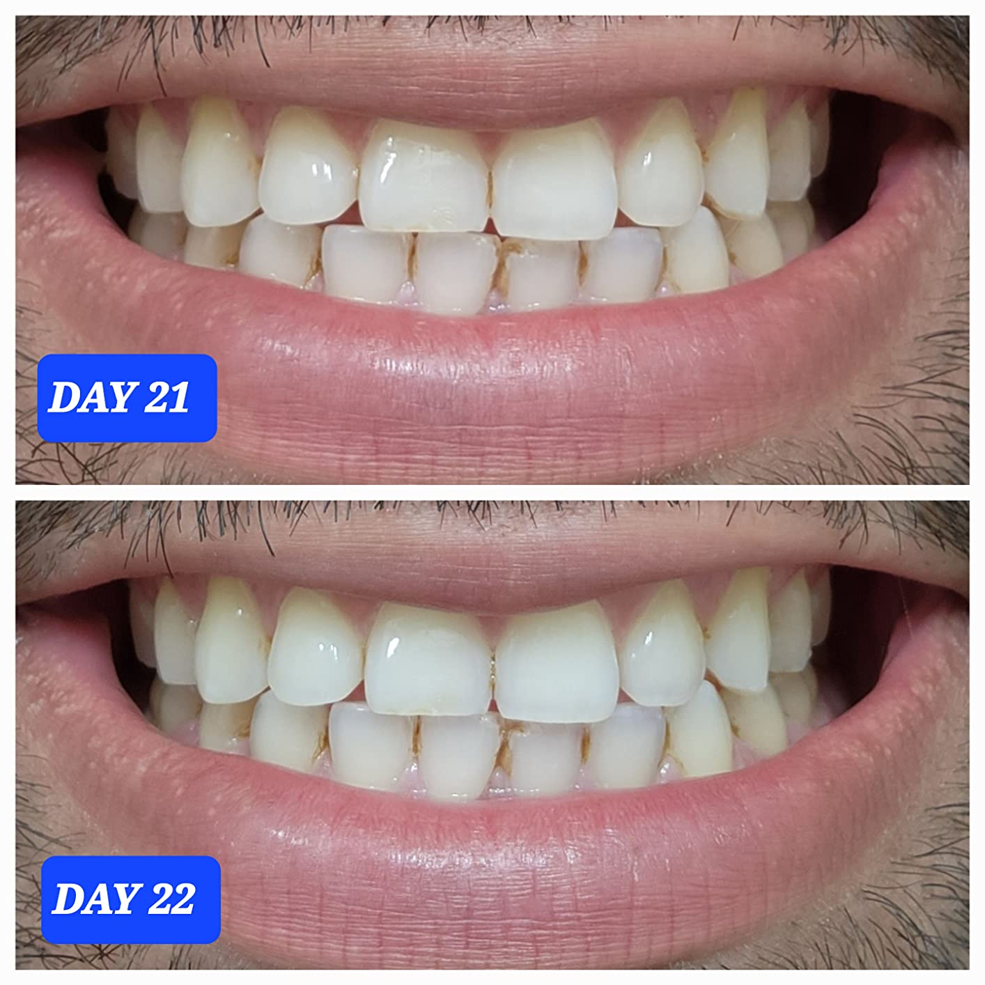 Crest 3D Whitestrips Professional Effects - Teeth Whitening Kit, 22 Treatments (20 + 2 Bonus), Each with 1 Upper/1Lower, 44 Strips - Crest 3DWhite Teeth Whitening Strips customer photo 1