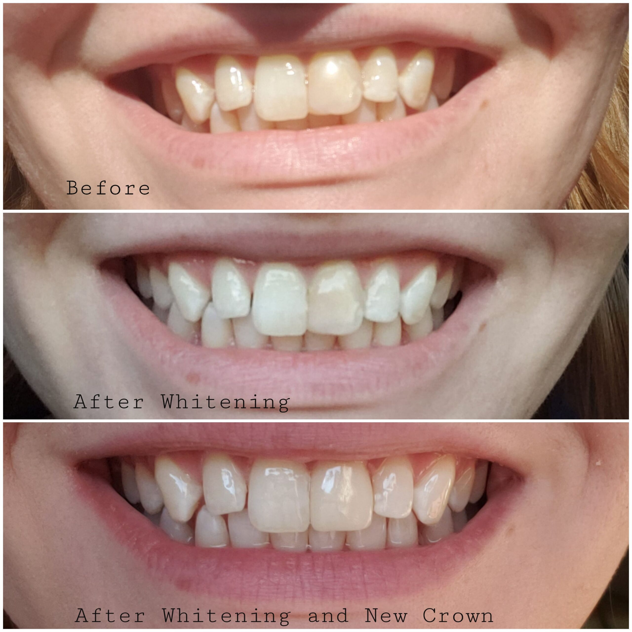 Opalescence Go 15- Prefilled Teeth Whitening Trays - 15% Hydrogen Peroxide - (10 Treatments) Made by Ultradent Products. Teeth Whitening Kit -Mint - 5194-1 customer photo 1