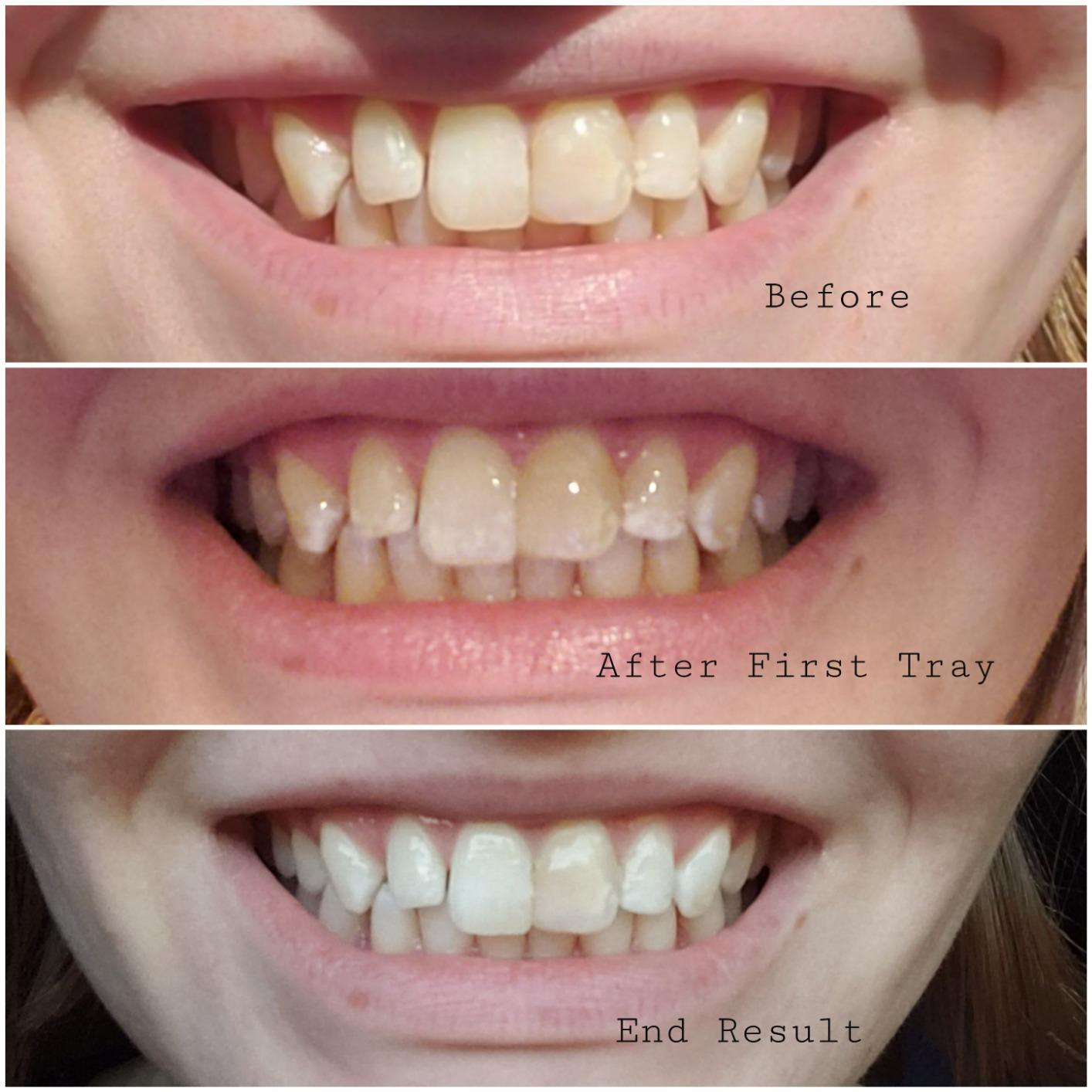 Opalescence Go 15- Prefilled Teeth Whitening Trays - 15% Hydrogen Peroxide - (10 Treatments) Made by Ultradent Products. Teeth Whitening Kit -Mint - 5194-1 customer photo 2