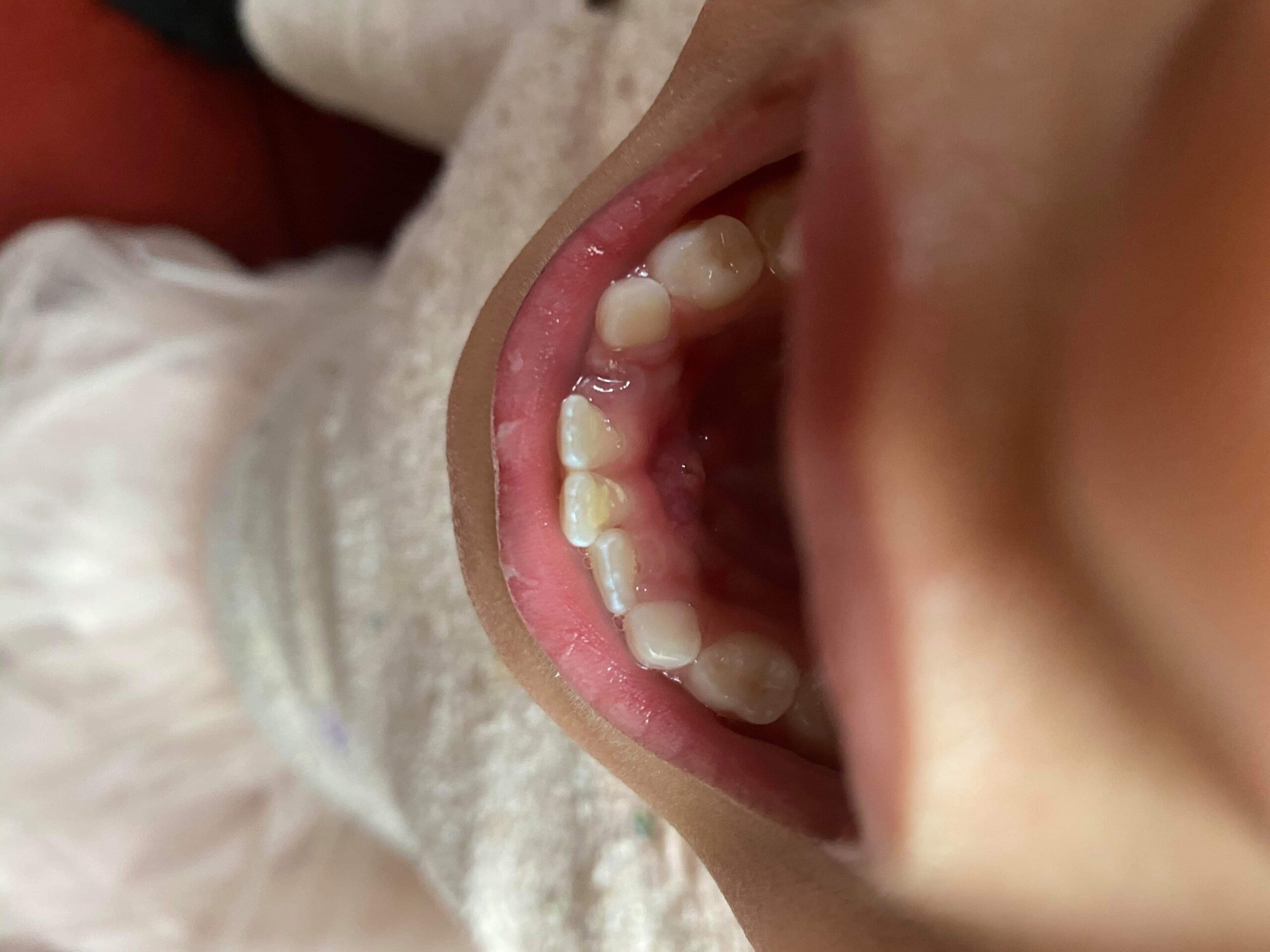 Utopia Care Professional Dental Tartar Scraper Tool, Dental Pick, Double Ended Tartar Remover for Teeth, Plaque Remover, Tooth Scraper, (1, Silver, 6.5 Inch) customer photo 2