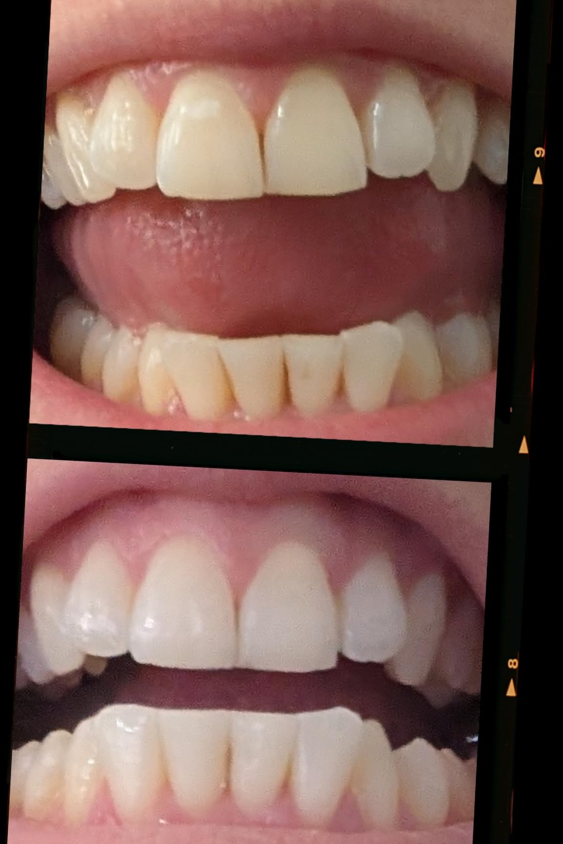 Auraglow Teeth Whitening Kit, LED Accelerator Light, 35% Carbamide Peroxide Teeth Whitening Gel, 20+ Whitening Treatments, Whitens up to 10 Shades in 7 Days customer photo 1