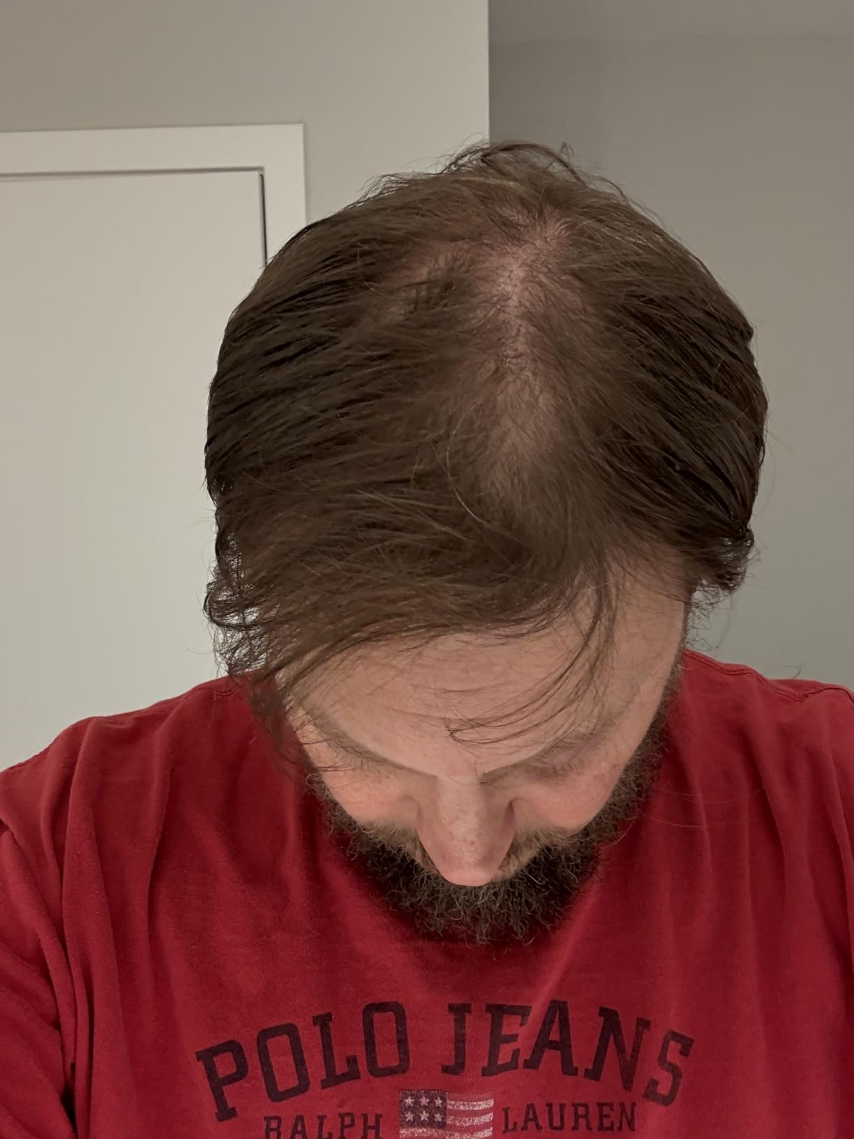 Theradome EVO Laser Hair Growth Helmet LH40 - 100% Laser, No Ineffective LEDs - FDA-Cleared Red Light Therapy for Hair Regrowth 4x Week customer photo 2