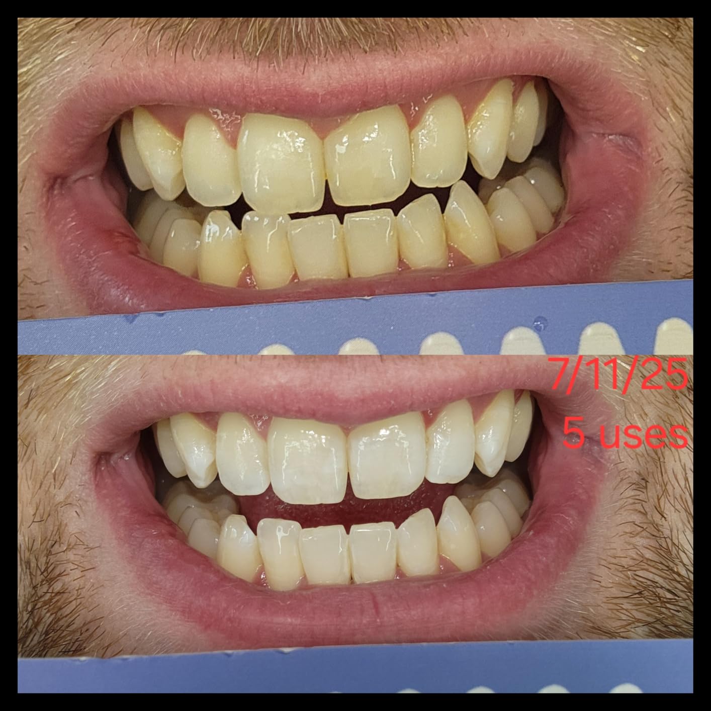 iSmile Teeth Whitening Kit - LED Light, 35% Carbamide Peroxide, (3) 3ml Gel Syringes, (1) Remineralization Gel, and Tray. customer photo 1