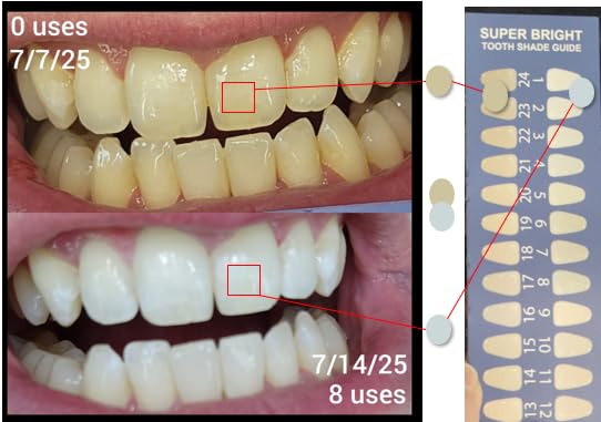 iSmile Teeth Whitening Kit - LED Light, 35% Carbamide Peroxide, (3) 3ml Gel Syringes, (1) Remineralization Gel, and Tray. customer photo 2