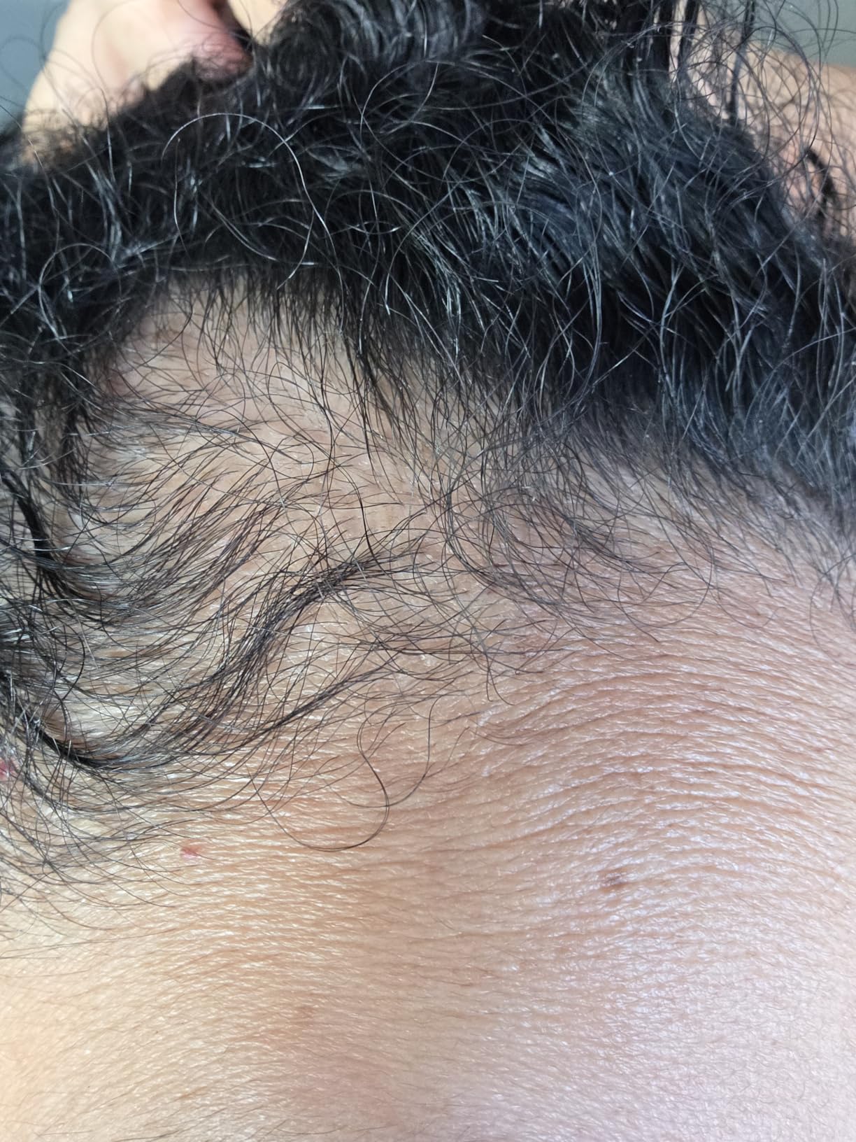 Derma Roller for Skin, Hair & Beard - Women and Men Titanium Microneedling Roller for Face & Scalp, Safe & Easy to Use 0.25mm customer photo 1