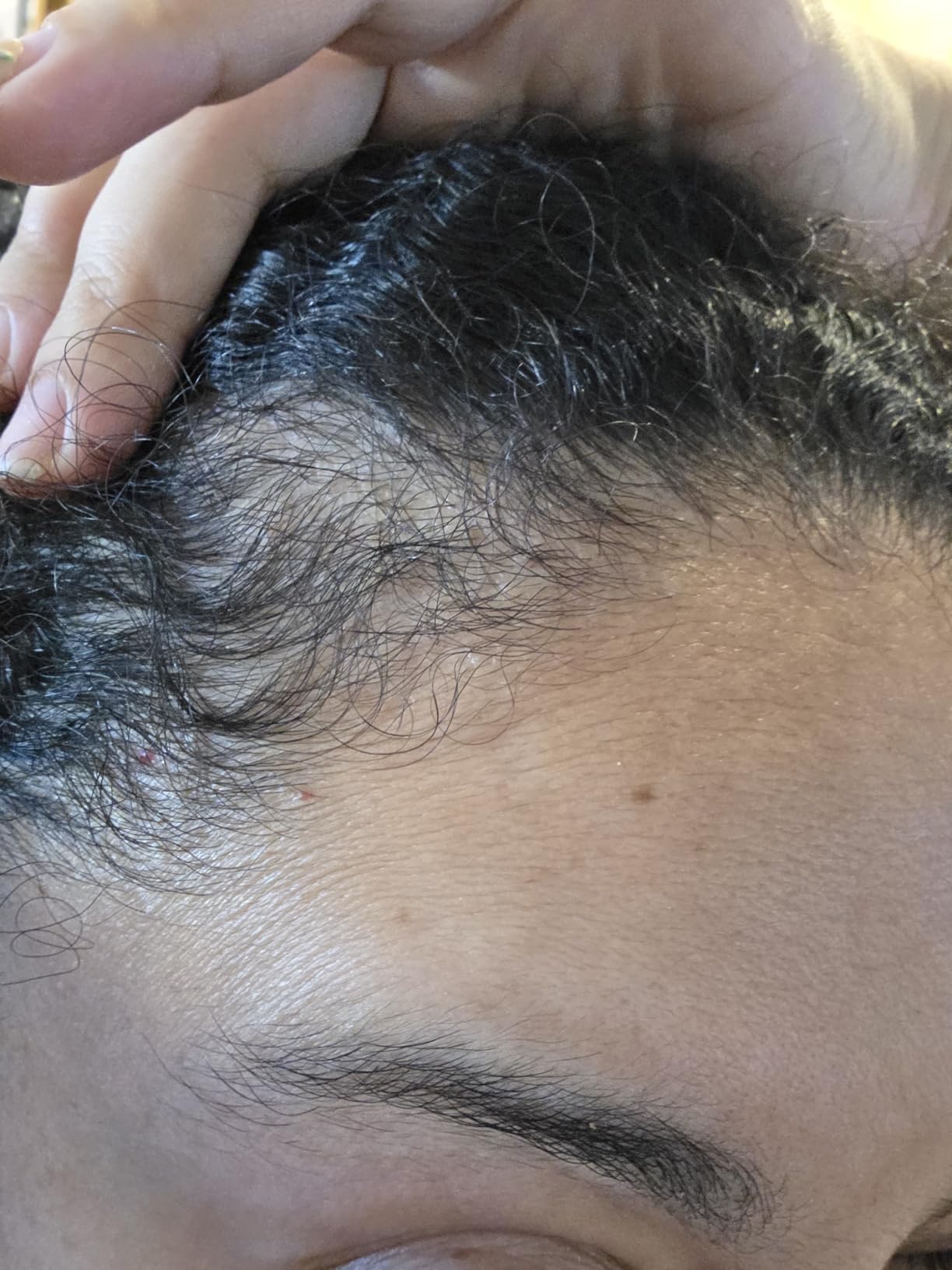 Derma Roller for Skin, Hair & Beard - Women and Men Titanium Microneedling Roller for Face & Scalp, Safe & Easy to Use 0.25mm customer photo 2