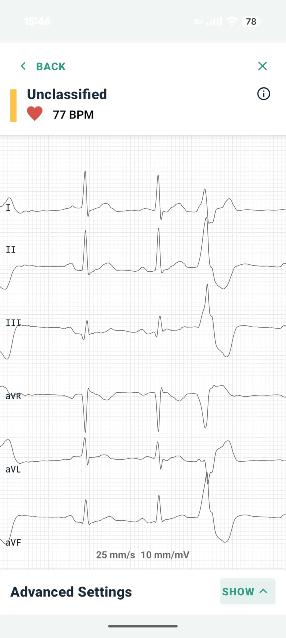 KardiaMobile 6L EKG Monitor, Medical-Grade, FDA-Cleared Heart Monitor, 6 Views of The Heart, Results in 30 Seconds, Unlimited Recordings, Works with Smartphones, HSA&FSA Eligible, Pocket-Size customer photo 2