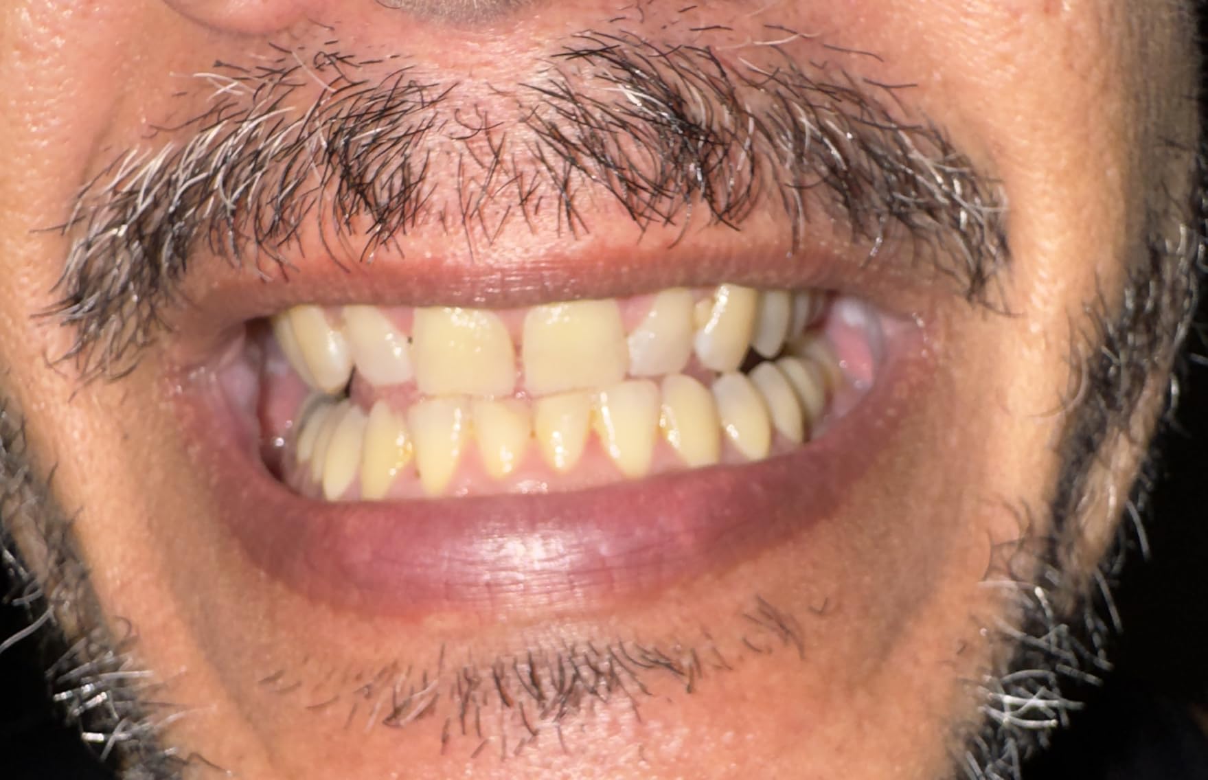 Crest 3D Whitestrips Glamorous White, 3D White, Teeth Whitening Strip Kit, 32 Strips (16 Count Pack) - Crest Teeth Whitening Strips, Teeth Whitening Kit - Packaging May Vary customer photo 1