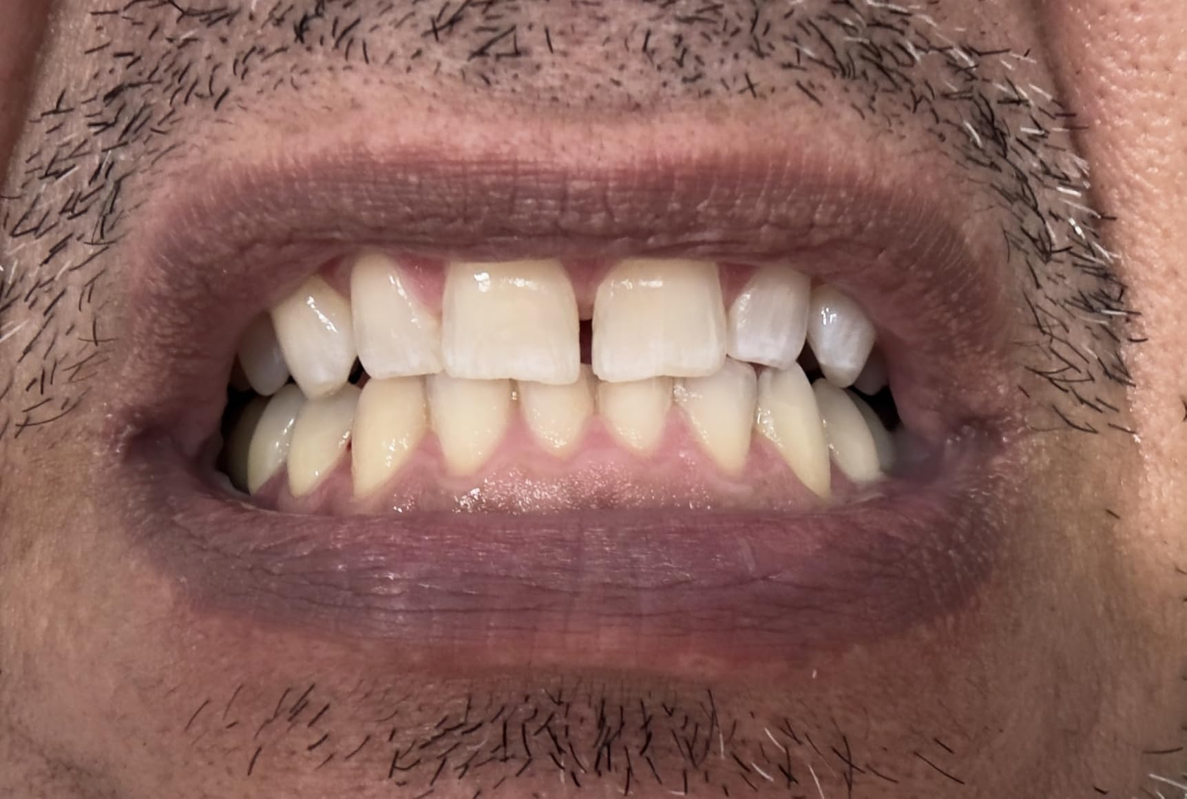 Crest 3D Whitestrips Glamorous White, 3D White, Teeth Whitening Strip Kit, 32 Strips (16 Count Pack) - Crest Teeth Whitening Strips, Teeth Whitening Kit - Packaging May Vary customer photo 2