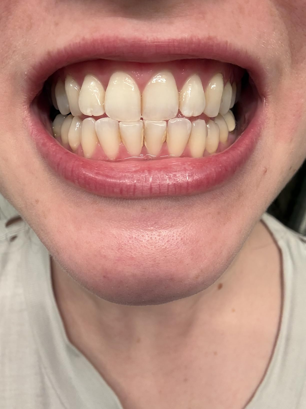 Dental Tools HOKIN Plaque Remover Teeth Cleaning Tool 4 Pcs Dental Care Kit Tooth Filling Repair Set Stainless Steel Dental Tools for Men Women Kids and Pet Care customer photo 1