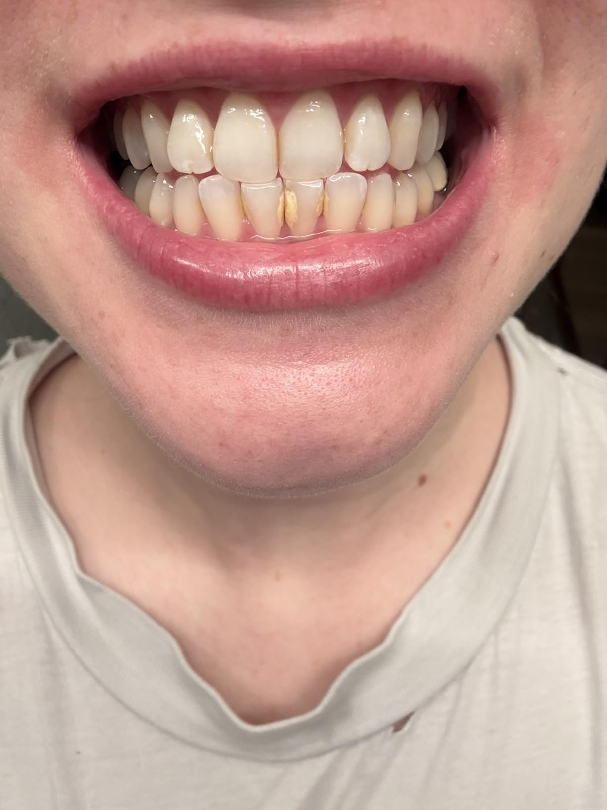 Dental Tools HOKIN Plaque Remover Teeth Cleaning Tool 4 Pcs Dental Care Kit Tooth Filling Repair Set Stainless Steel Dental Tools for Men Women Kids and Pet Care customer photo 2