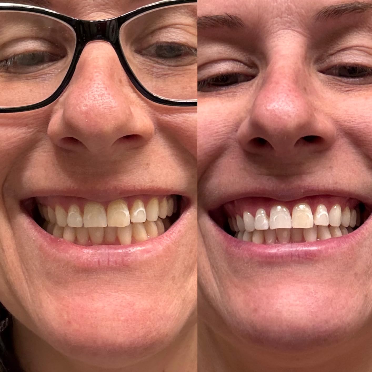 Lumineux Teeth Whitening Strips Kit - 9 Treatments (1 Month) - Peroxide Free - Enamel Safe for Whiter Teeth - Whitening Without The Sensitivity - Dentist Formulated - Sensitivity Free customer photo 1