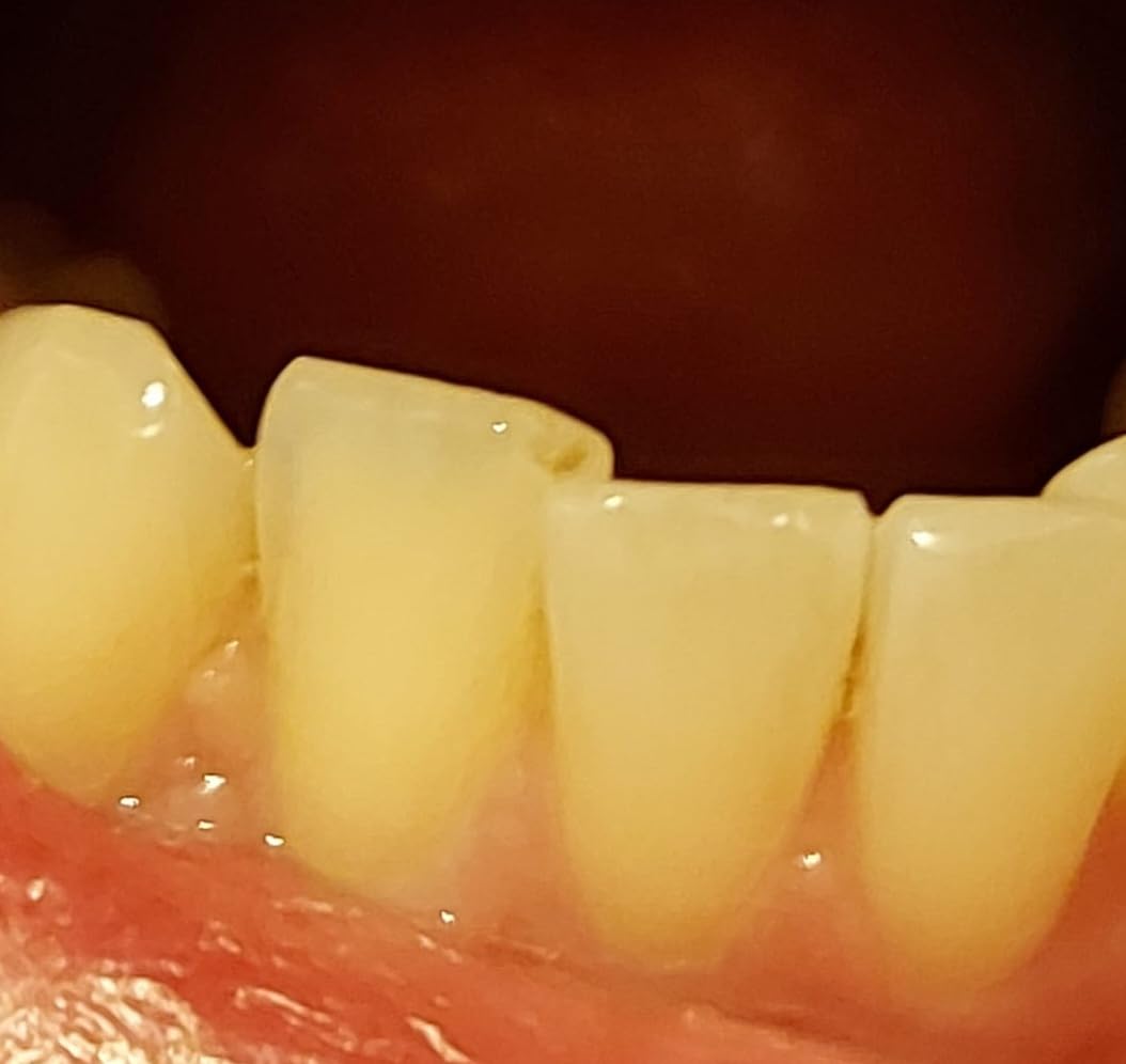 SmartGuard Anti Snore Device. New Customizable Snore Reducing Mouthpiece - Reduce Snoring Aid for Men and Women - Most Comfortable and Adjustable Oral Appliance - Holds Jaw Forward to Open Airway customer photo 2