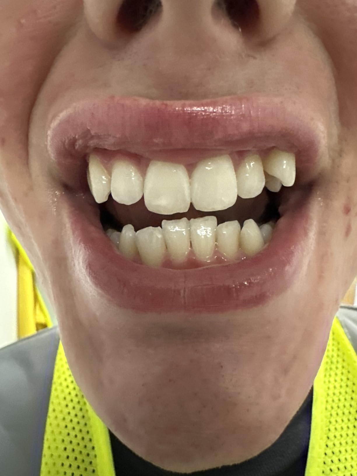 GuruNanda Teeth Whitening Strips - 7-Day Treatment with Non-Slip, Dry Strip Technology - Whitening Designed with Care for a Brighter Smile customer photo 1