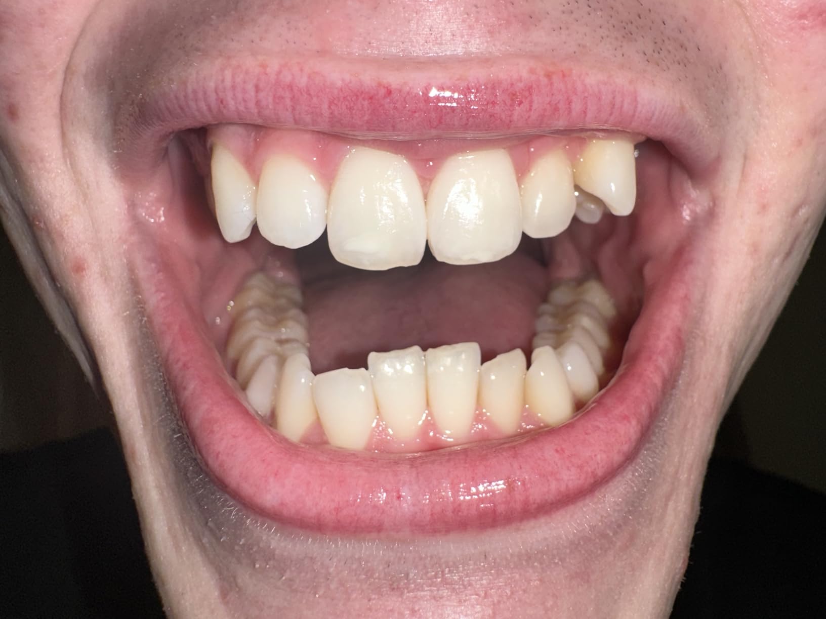 GuruNanda Teeth Whitening Strips - 7-Day Treatment with Non-Slip, Dry Strip Technology - Whitening Designed with Care for a Brighter Smile customer photo 2