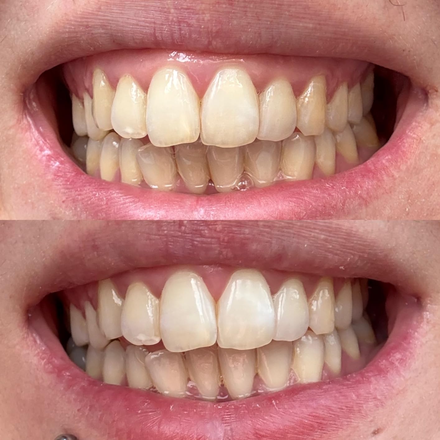 Crest 3D Whitestrips Sensitive White - Teeth Whitening Kit, 18 Treatments, Each with 1 Upper/1Lower, 36 Strips - Crest 3DWhite Teeth Whitening Strips customer photo 1