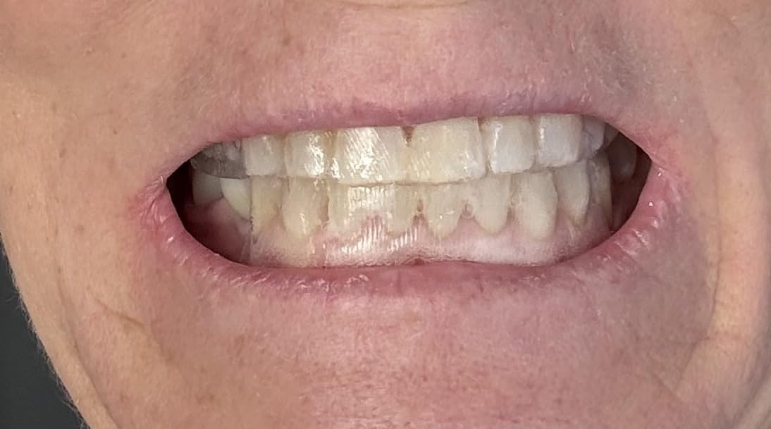 Crest 3D Whitestrips Sensitive White - Teeth Whitening Kit, 18 Treatments, Each with 1 Upper/1Lower, 36 Strips - Crest 3DWhite Teeth Whitening Strips customer photo 2