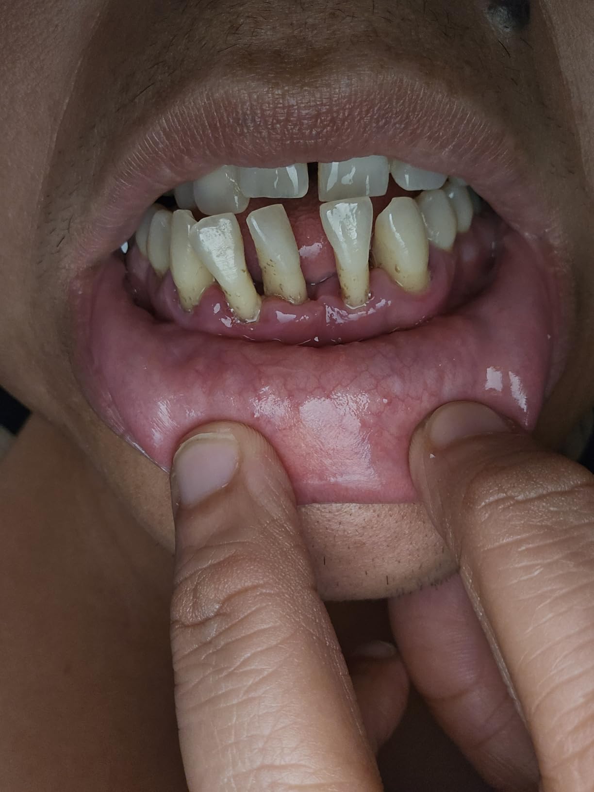 Plaque Remover for Teeth, Tartar Remover for Teeth Cleaning with 4 Replaceable Heads and 3 Adjustable Modes, Rechargeable Teeth Cleaning Plaque Remover for Home customer photo 1