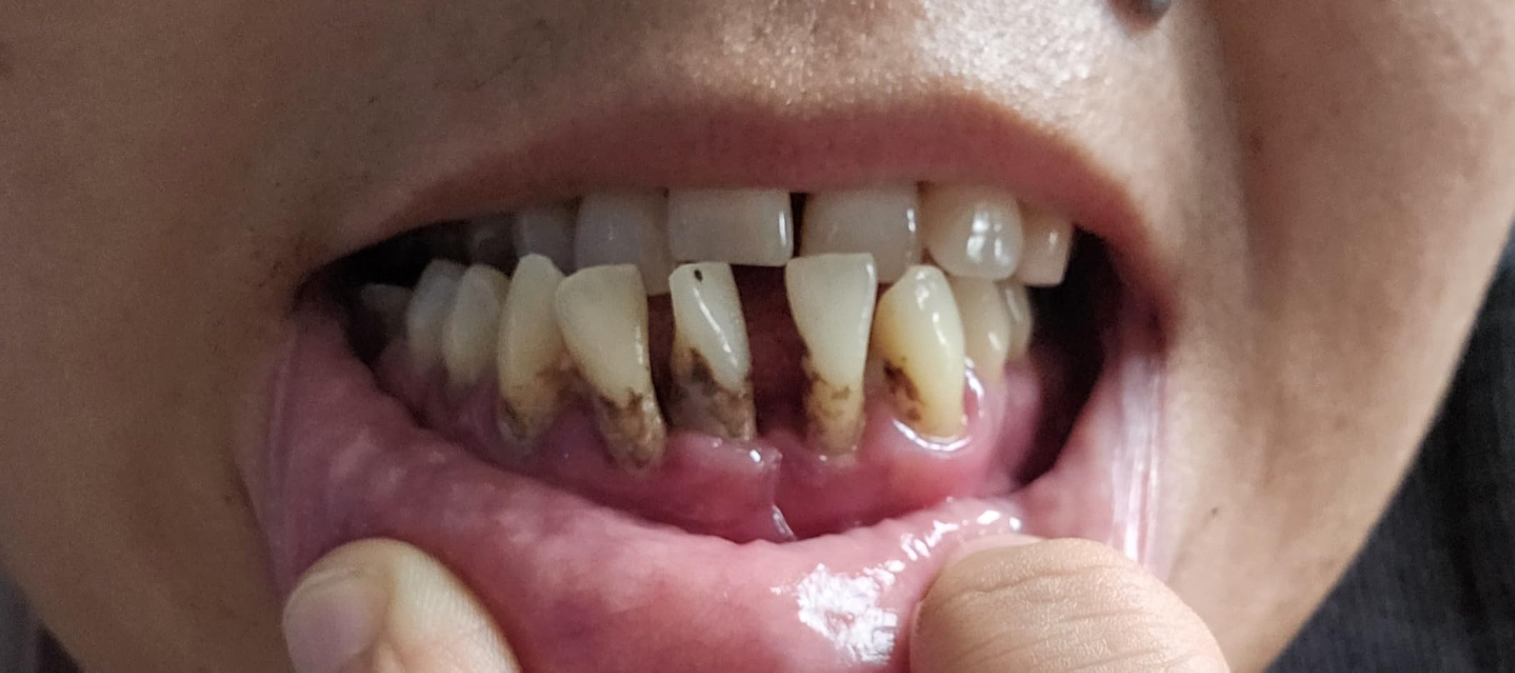 Plaque Remover for Teeth, Tartar Remover for Teeth Cleaning with 4 Replaceable Heads and 3 Adjustable Modes, Rechargeable Teeth Cleaning Plaque Remover for Home customer photo 2