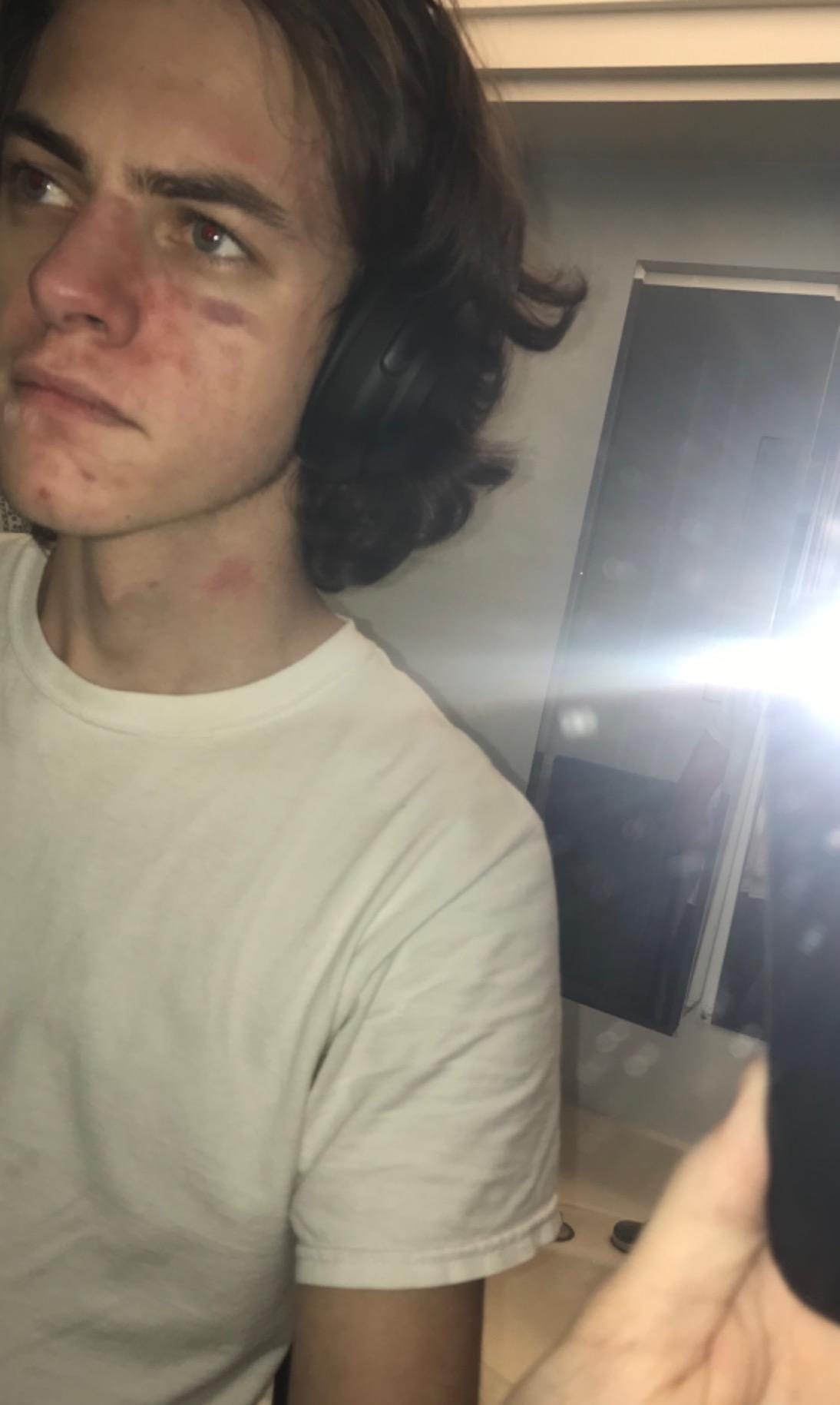 Blackhead Remover Pore Vacuum Upgraded Facial Pore Cleaner Electric Comedone Whitehead Extractor Tool-5 Suction Power,5 Probes,USB Rechargeable Blackhead Vacuum Kit for Women & Men customer photo 1