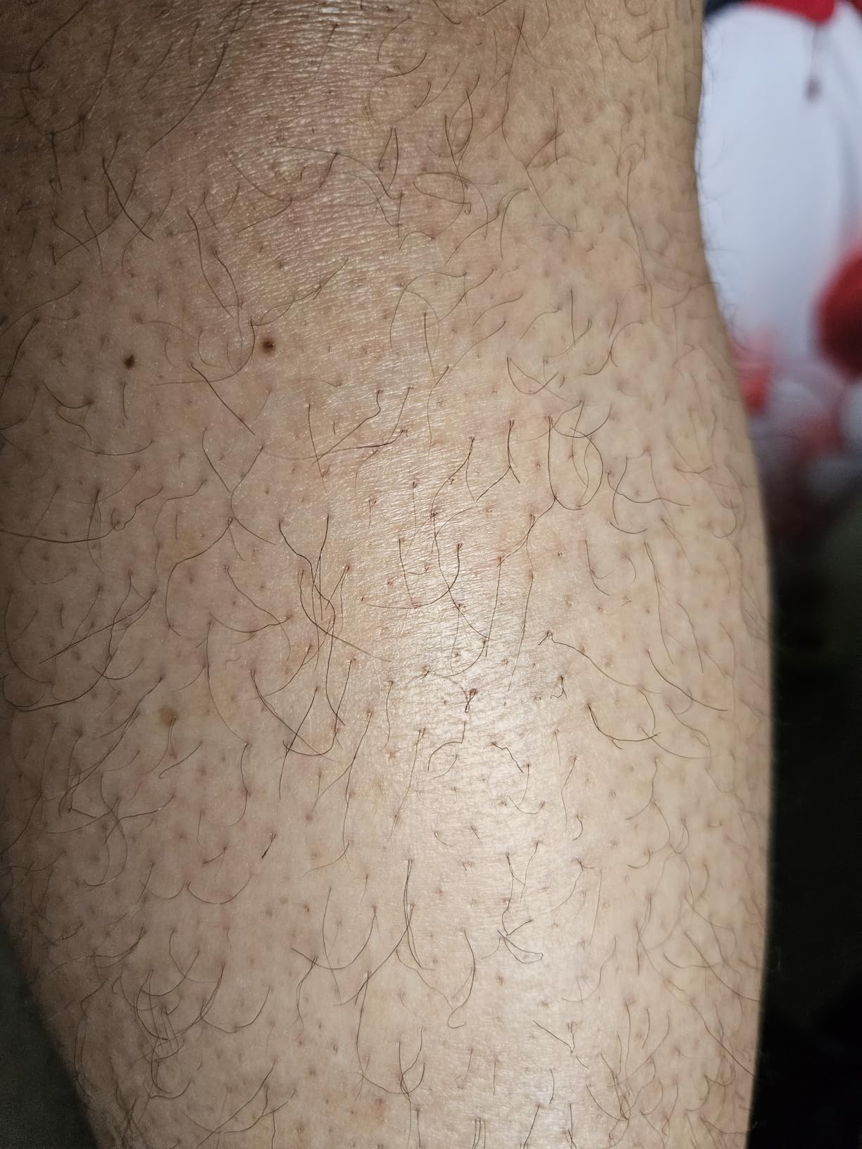 Ulike Laser Hair Removal Device Air 10 IPL for Women and Men, Ice Cool and Permanent Hair Reduction for Nearly Painless, Dual Lights, Skin Sensor & USHR Mode Hair Removal in 10mins from Home customer photo 1