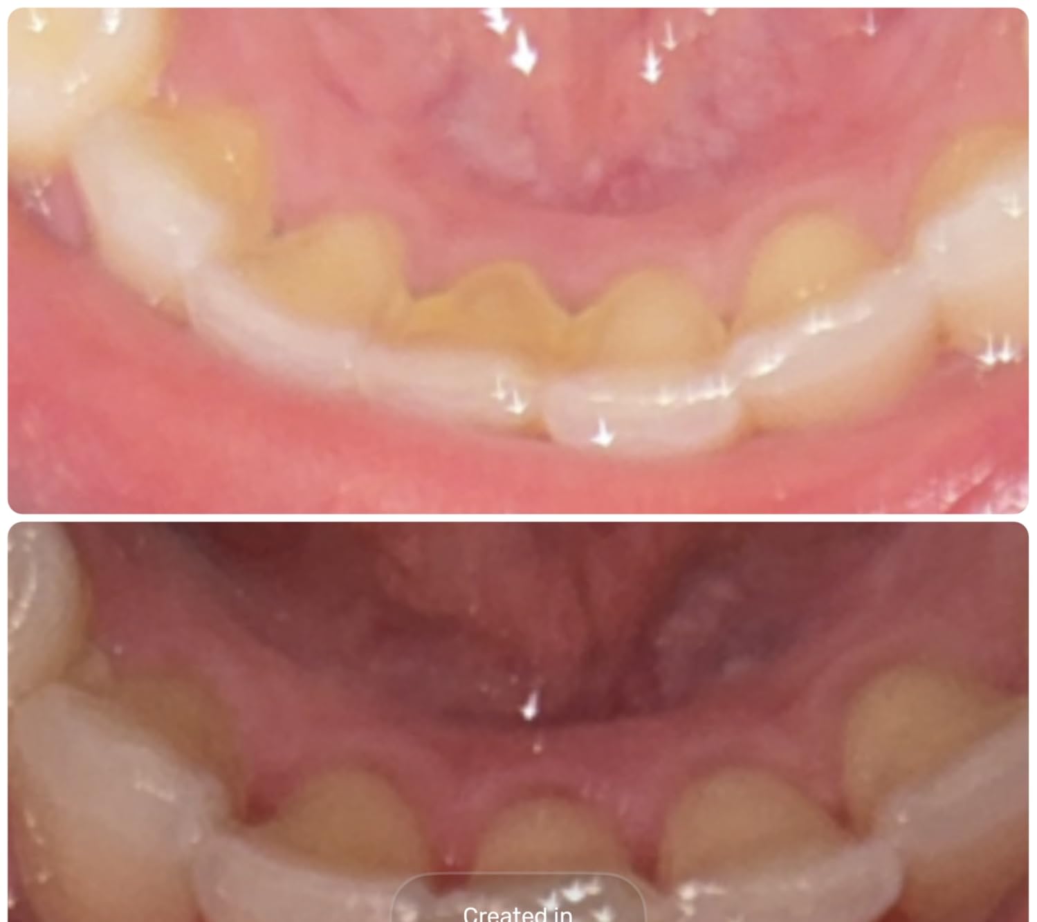 Plaque Remover for Teeth, Dental Cleaning Kit Tartar Remover for Teeth with LED Light & 5 Modes, Rechargeable Dental Cleaner, 4 Replaceable Heads customer photo 2