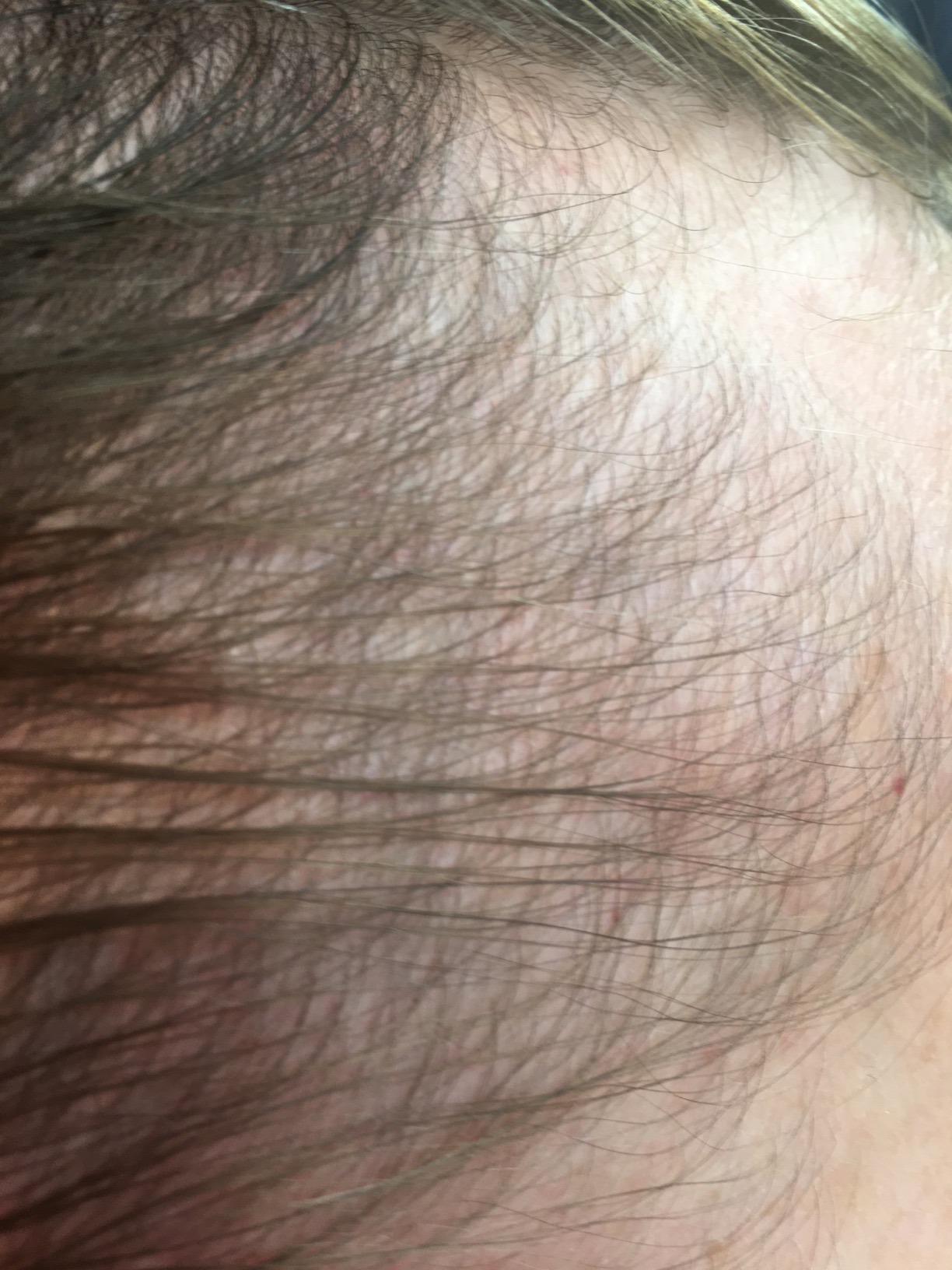 Hairmax Ultima 12 Classic LaserComb - (FDA Cleared) Laser Hair Regrowth Treatment Device for Men & Women - Cordless Design customer photo 1