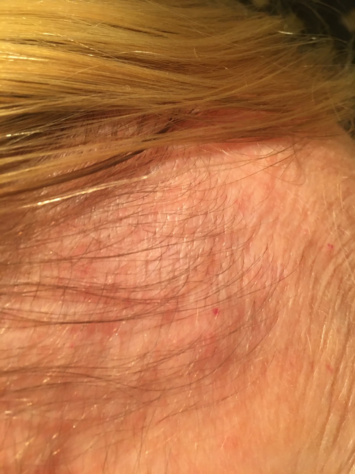 Hairmax Ultima 12 Classic LaserComb - (FDA Cleared) Laser Hair Regrowth Treatment Device for Men & Women - Cordless Design customer photo 2