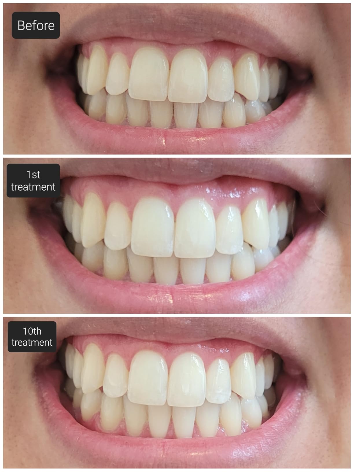 Crest 3D Whitestrips Whitening Starter Kit - Teeth Whitening Kit, 10 Treatments, Each with 1 Upper/1Lower, 20 Strips - Crest 3DWhite Teeth Whitening Strips customer photo 2