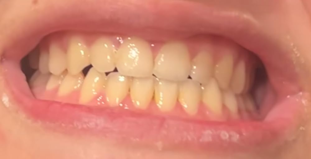 GuruNanda Professional Teeth Whitening Wireless Kit with LED Light & Whitening Pen, Helps Remove Surface Stains from Coffee, Food, Soda, 40 Treatments customer photo 1