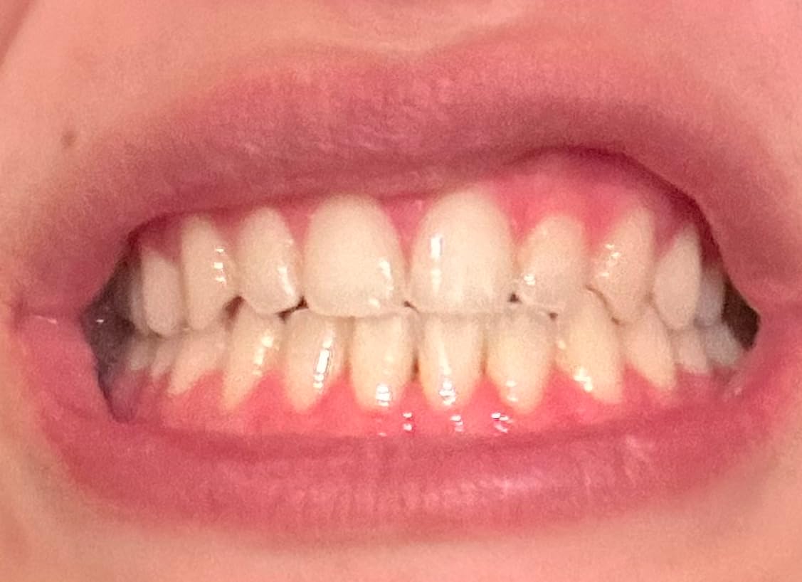 GuruNanda Professional Teeth Whitening Wireless Kit with LED Light & Whitening Pen, Helps Remove Surface Stains from Coffee, Food, Soda, 40 Treatments customer photo 2