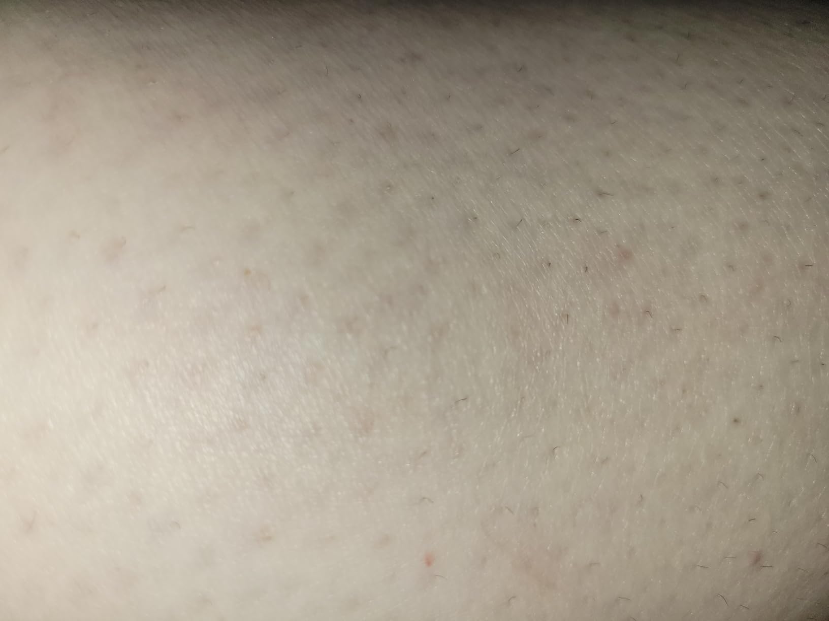 IPL Laser Hair Removal Device for Women & Men - Home 45°F Ice-Cooling Contact for Painless & Long-Lasting Results, 86% Hair Reduction in 3 Weeks for Full Body & Bikini Line, Rose Gold customer photo 1