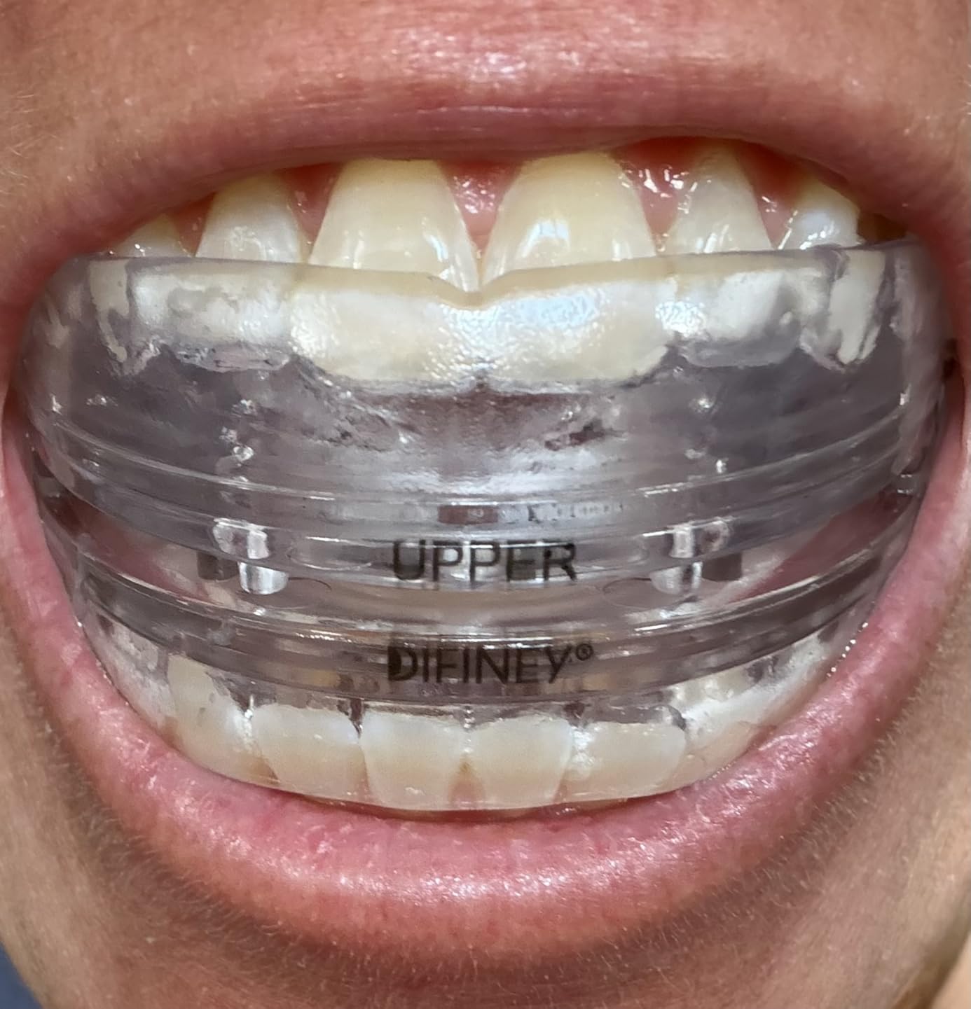 Advanced Anti Snoring Device 4.0: FDA-Cleared Snoring Solution - Adjustable Snore Stopper Mouth Guard for Men & Women - Anti Snoring Mouthpiece to Improve Sleep - Reusable Night Use customer photo 2