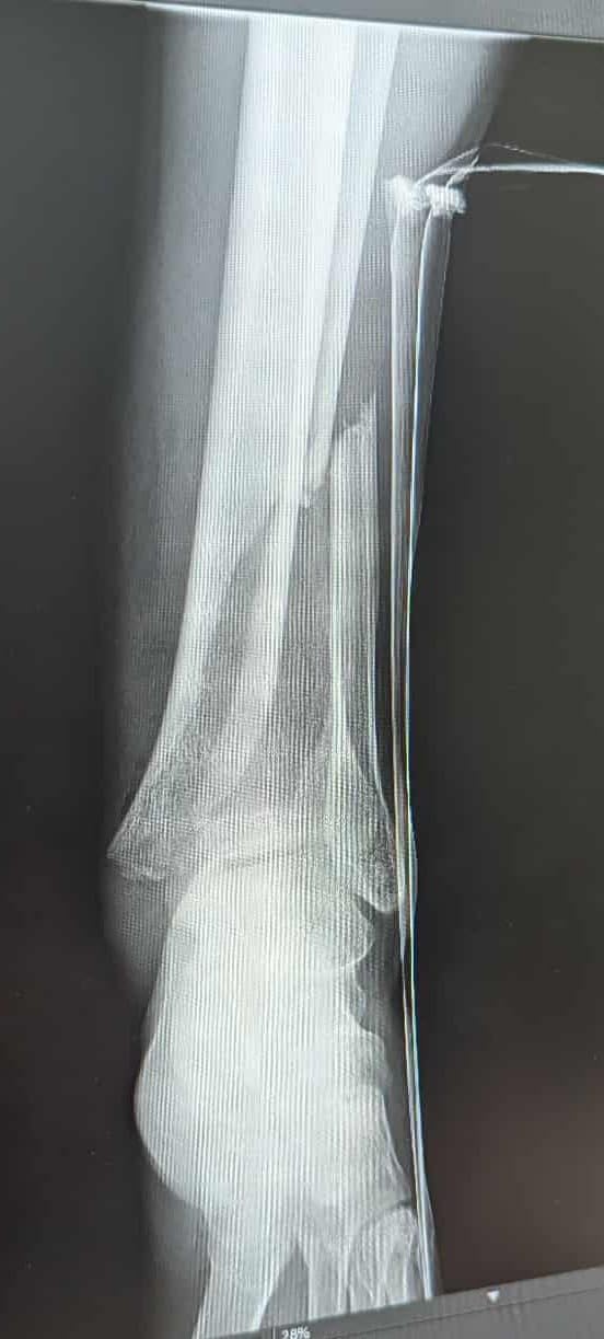 MEEPO Bamboo Series Off-Road All Terrain Electric Skateboard, Ultra-Long 20-31 Miles Range Mountain Board, Highest 28-32 MPH Top Speed, 155-175mm Wheels, Professional for Adult Riders customer photo 2