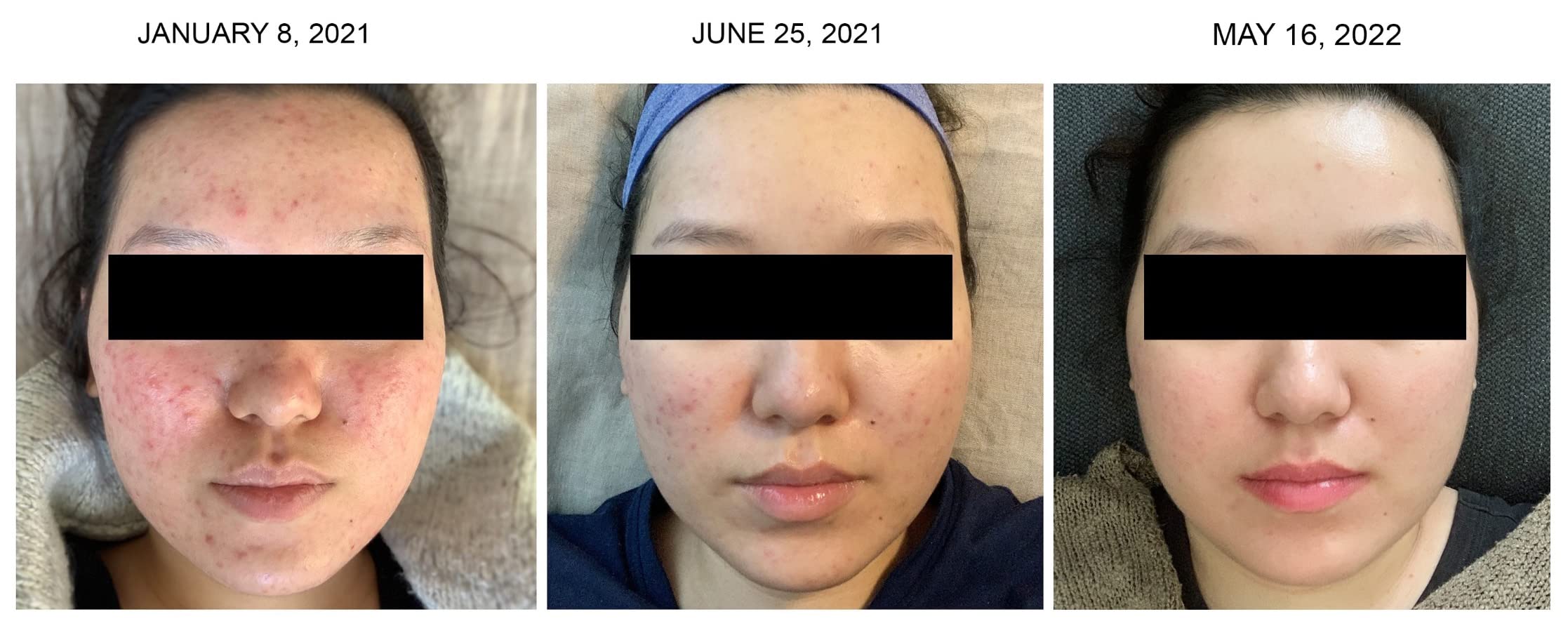 Hydraskincare PDT LED Red Light Therapy for Face Mask Facial Skin Care Rejuvenation Photon Therapy Machine customer photo 1