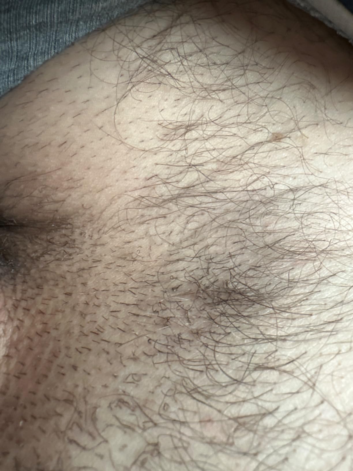 Braun Smart IPL, Skin i-Expert Pro 7, VOGUE's Best Hair Removal Device, 3 Heads, IPL7243 customer photo 2