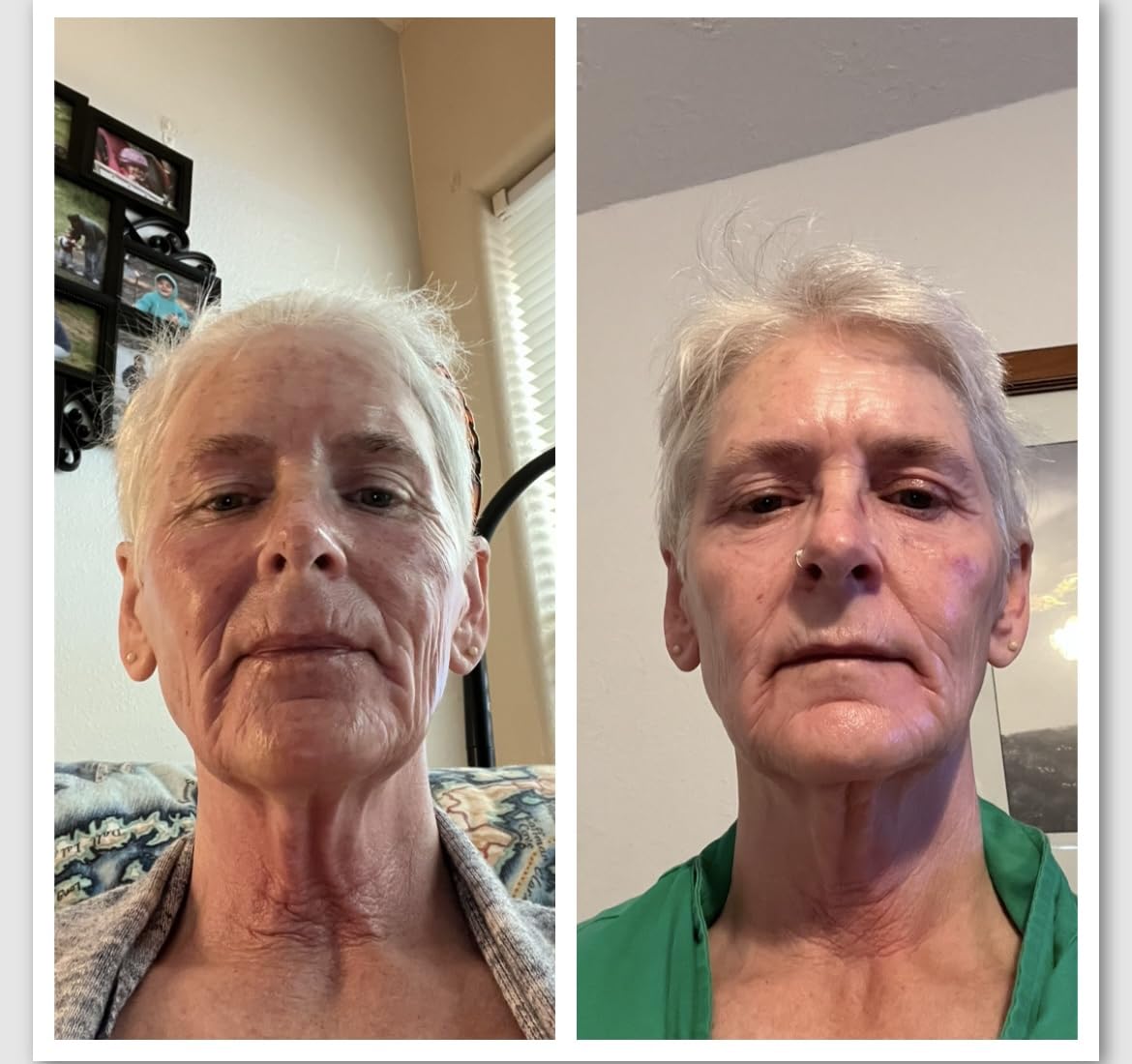 The Ordinary AHA 30% + BHA 2% Peeling Solution, Advanced Exfoliating Peel for Brighter Skin customer photo 2