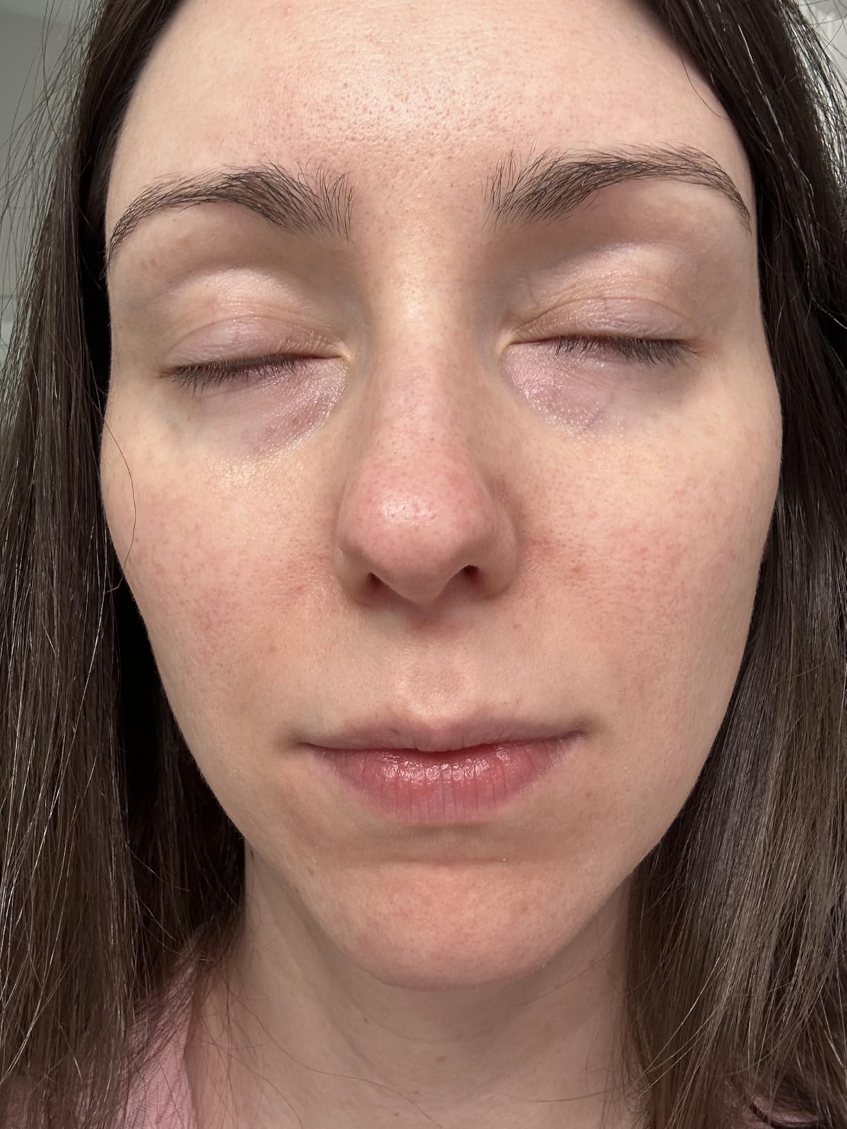 Anua Azelaic Acid 10 Hyaluron Redness Soothing Serum, Facial Serum for Blemish-Prone & Oily-Prone Skin, Lightweight & Hydrating Blemish Care, Korean Skincare, 1.01 fl oz customer photo 1