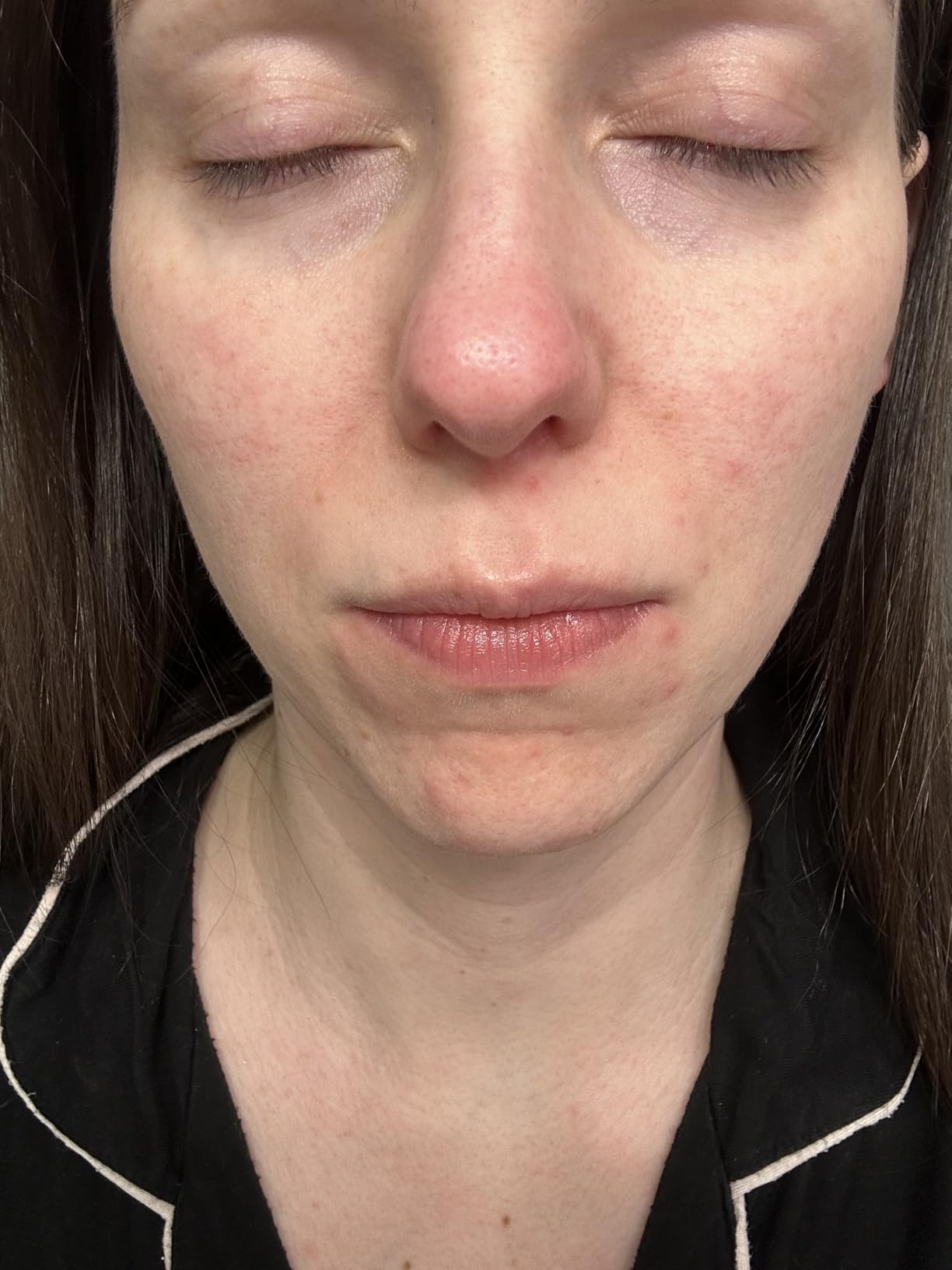 Anua Azelaic Acid 10 Hyaluron Redness Soothing Serum, Facial Serum for Blemish-Prone & Oily-Prone Skin, Lightweight & Hydrating Blemish Care, Korean Skincare, 1.01 fl oz customer photo 2