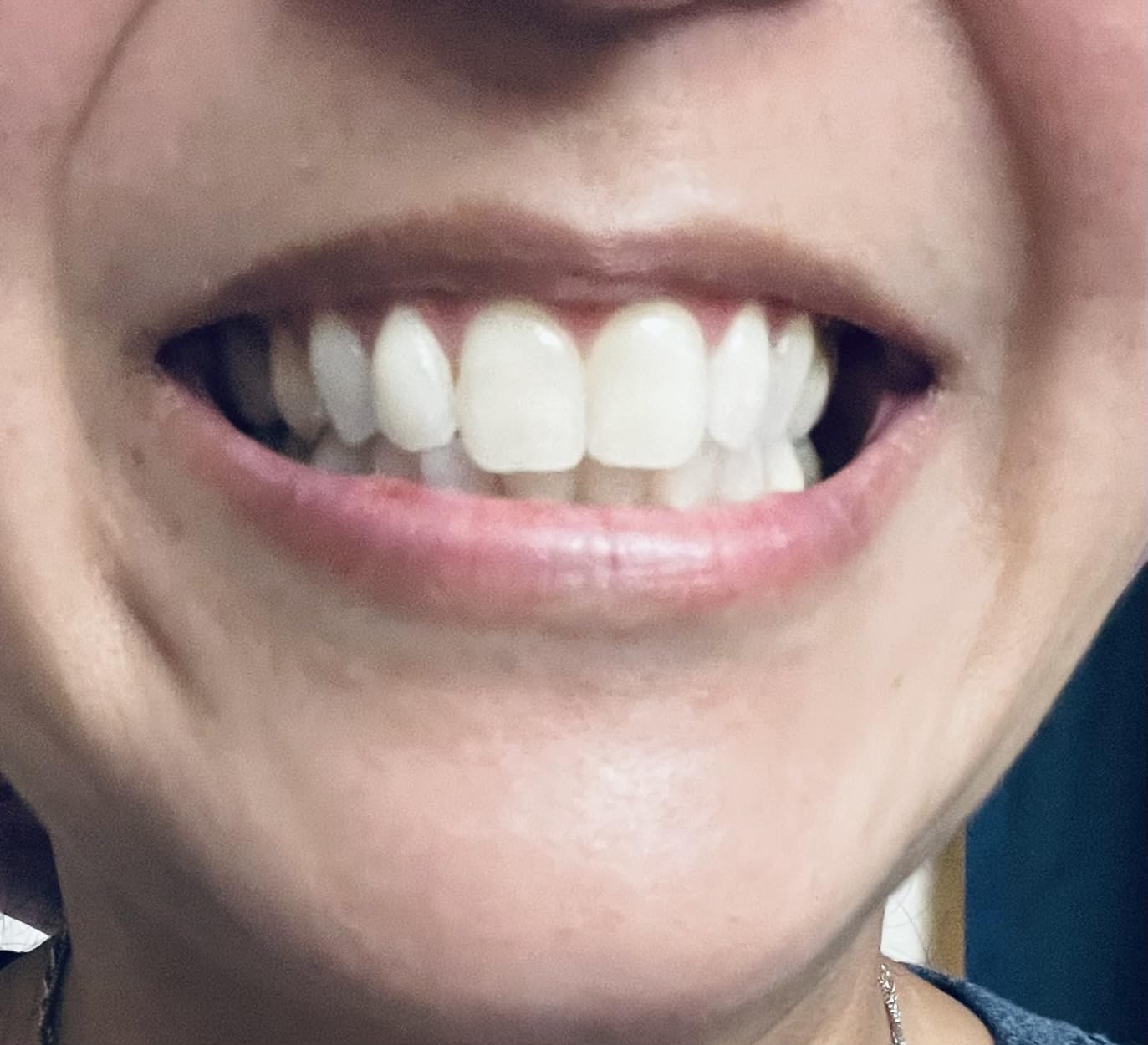 Philips Sonicare DiamondClean 9300 Electric Toothbrush, 2 Brush Head, Black | 2000% More Plaque Removal, Visual Pressure Sensor, 12 Brush Settings, App Connected, 14-Day Battery, Travel Case, HX9903/15 customer photo 1